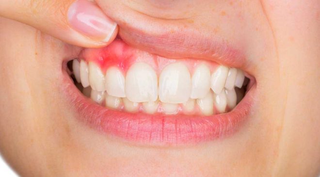 Uzmanlardan kritik uyarı: Diş eti kanaması ihmal edilmemeli