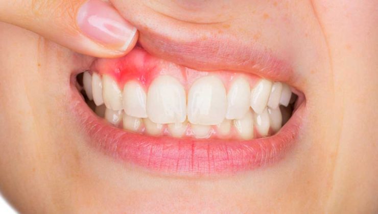 Uzmanlardan kritik uyarı: Diş eti kanaması ihmal edilmemeli